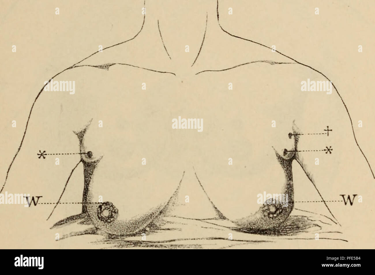 . Der Bau des "Menschen als Zeugnis für seine Vergangenheit. Menschliche Wesen; Anatomie, Vergleichende. Hautdi - Üsen (Milchdrüsen). 17 zu Fukiii zur henkes lolland kam; sie zeigte sich im übrigen normal entwickelt und Awaren vom 15. Lebensjahr eine Menstruiert. - Lieber der normalen, gut ausgebildeten Warze, 4cm von letzterer entfernt, sitzt jederseits eine zweite Warze, erbsengrosse dmikel pigmentiert und über-haupt ganz von demselben Verhalten, wie die richtige Warze. Nach oben und seitlich ziemlich weit von der normalen Mamma jederseits befindet sich noch eine zweite kleinere Mamma mit je einer Warze. - Stockfoto