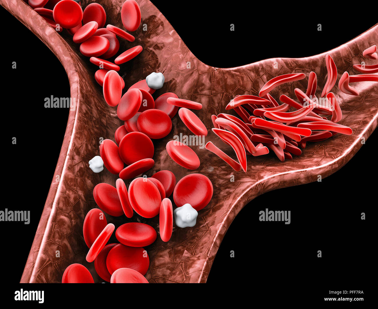 Sichelzellenanämie, 3D-Illustration Blutgefäß mit normalen und Crescent verformt Stockfoto