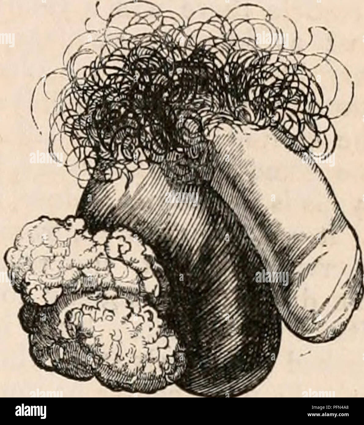 . Die cyclopaedia von Anatomie und Physiologie. Anatomie, Physiologie, Zoologie. Viel vergrößert; sein Kopf war mit weichen Beton Materie gefüllt, um eine unregelmäßige Hohlraum mit dem ein fistulous Sinus com-municated; sein Schwanz enthielt einen ähnlichen Standpunkt ohne externe Öffnung. Die verschiedenen beschriebenen Erscheinungen sind in der nebenstehenden Abbildung, die aus der jüngsten Probe genommen wurde, dargestellt. Ähnliche Erscheinungen, die in diesem Fall bemerkt haben, beschrieben und durch Cruveilhier, in seiner "Anatomie Pathologique." * Er der Auffassung ist, dass die Krankheit Erlösen aus dem Leiter der dar Stockfoto