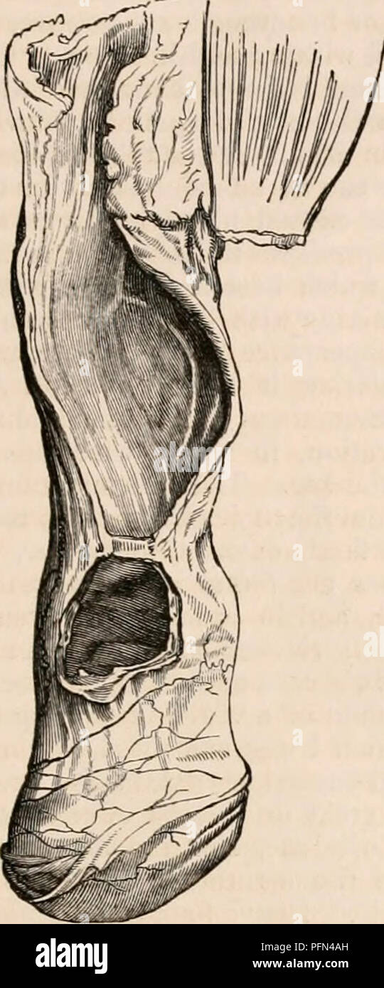 . Die cyclopaedia von Anatomie und Physiologie. Anatomie, Physiologie, Zoologie. Hoden (abnormalen Anatomie). Oberhalb der Hoden in engem Kontakt mit der Tunica vaginalis. Unmittelbar oberhalb dieser Zyste, sondern ganz aus sie unterscheidbar, gab es eine enge und leeren seröse Sac drei Zentimeter in der Länge, mit einer verkürzten Hals, und die Kommunikation mit dem Bauch. Sie sind in der beigefügten Gravur stellte, mit dem hernial sac Abb. 644.. offen gelegt, und ein Teil der parietes der Encysted hydrocele und schneiden Sie Ihre Innenräume zu entlarven. Die Position der Hoden ist so verändert, dass der anterioren Grenze dire ist Stockfoto