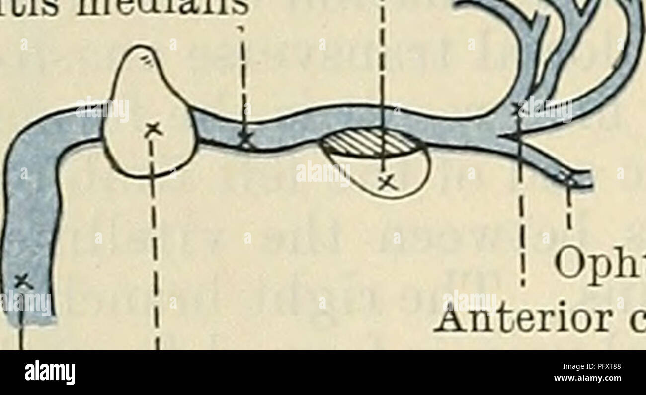 Eine Illustration aus Cunninghams Lehrbuch über Anatomie mit Schwerpunkt auf das Venensystem und die Blutzirkulation zwischen Plazenta und Leber in der fetalen Entwicklung. Die Arbeit beschreibt die Strukturen und Funktionen des Kreislaufsystems während der Trächtigkeit. Stockfoto