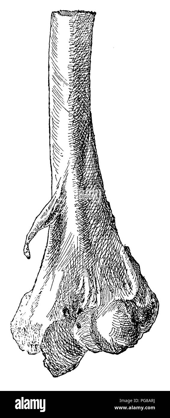 Prozess supracondyloideus. Nach einer Vorbereitung der anatomischen Sammlung der Universität Heidelberg, 1902 Stockfoto