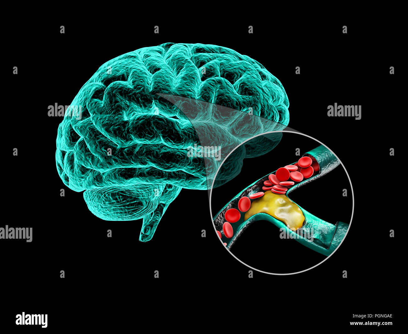Menschliche Gehirn mit zerebraler Sklerose. Die menschliche Anatomie