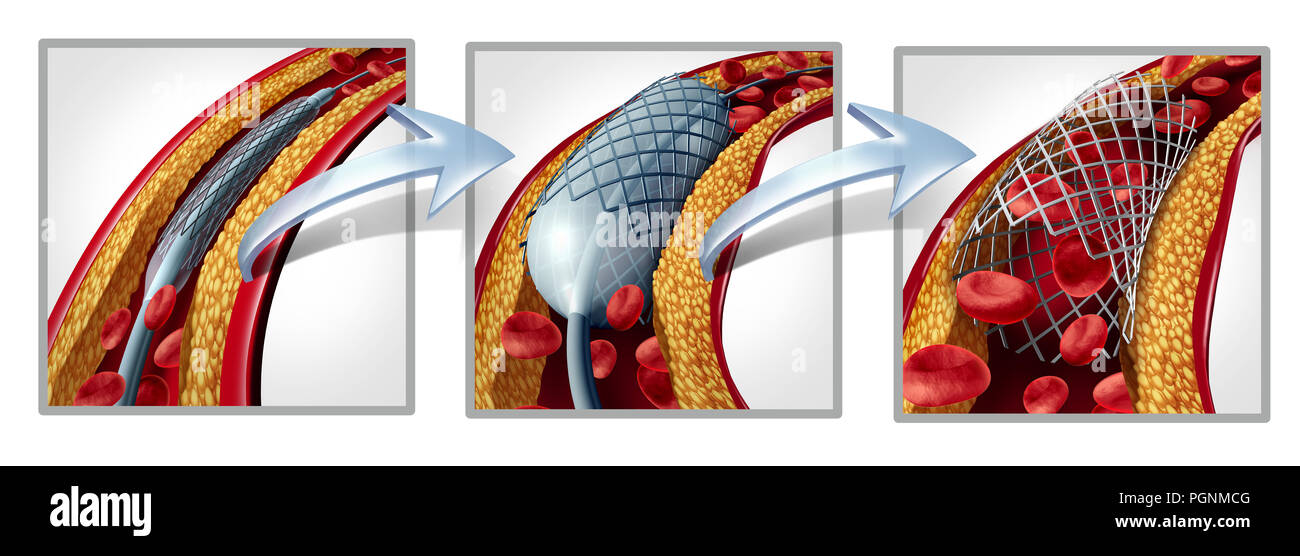 Koronare stent und angioplastie Konzept als Herzkrankheit Behandlung symbol Diagramm mit den Phasen eines Verfahrens Implantat in einer Arterie. Stockfoto