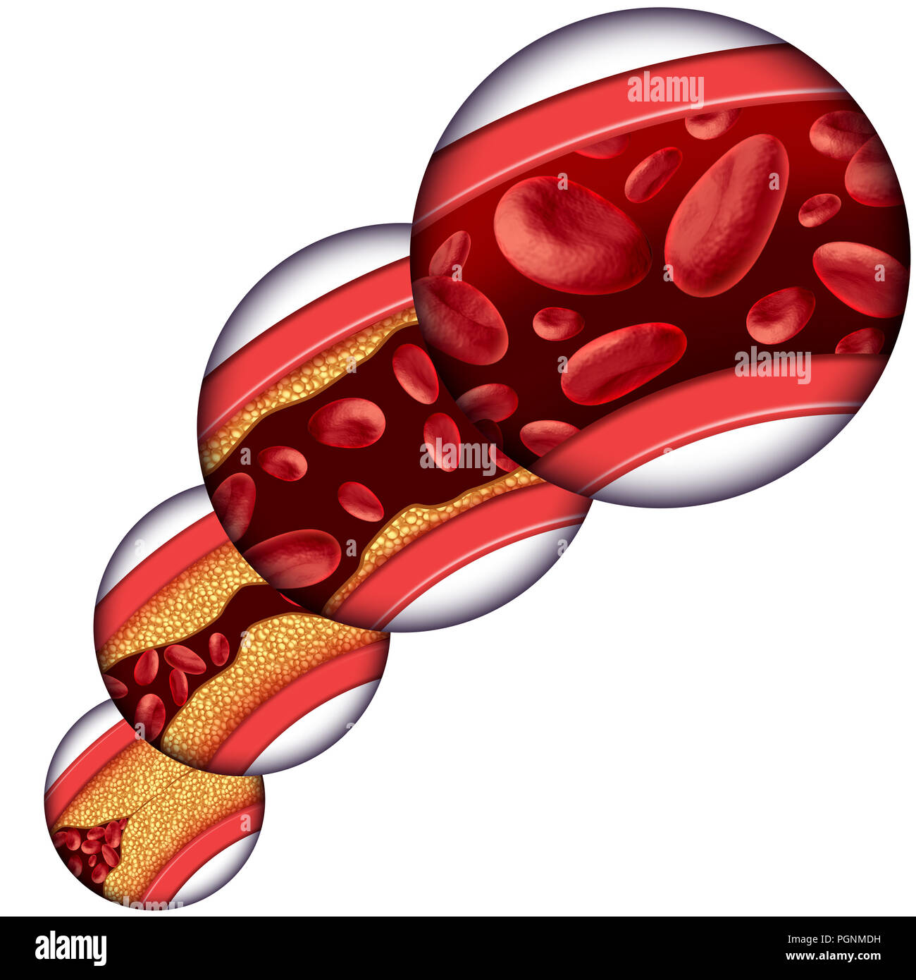 Koronare Cholesterin Therapie medizinisches Konzept wie eine Vene mit schrittweisen Entfernung von Plaque aus verstopften Arterien und Atherosklerose. Stockfoto