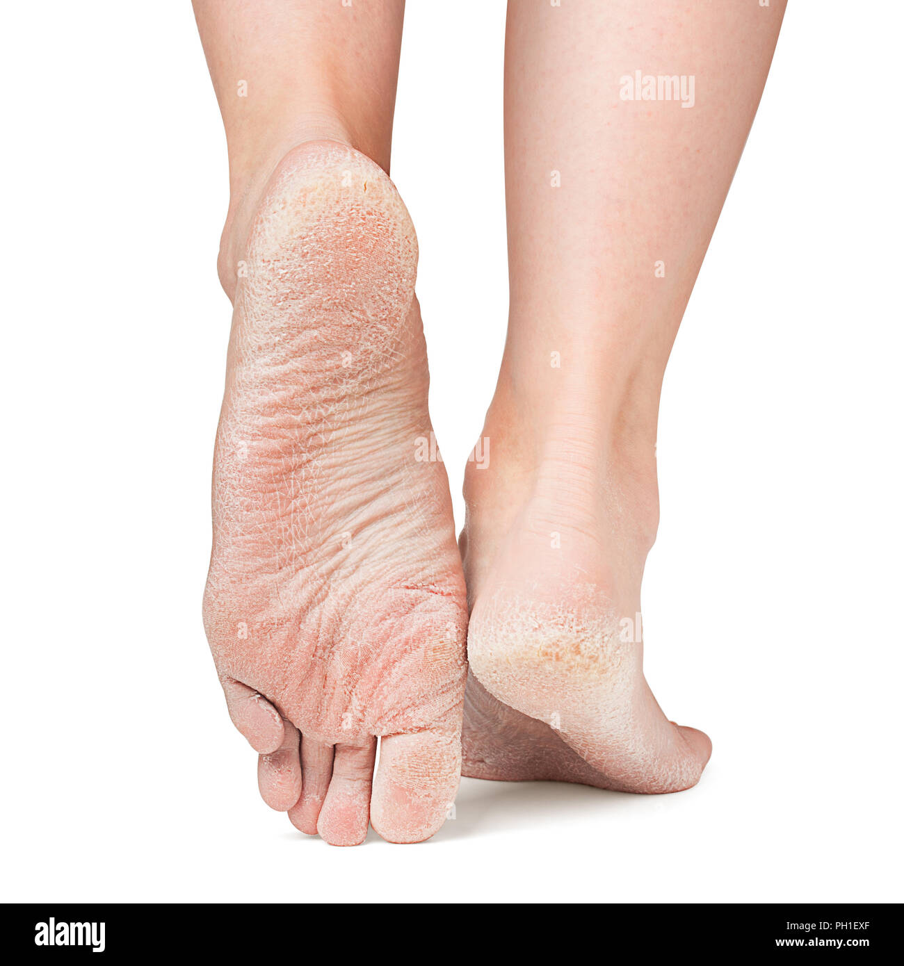 Wunde Haut der Füße, Crack, chemische Fersen, Freistellungspfad Stockfoto