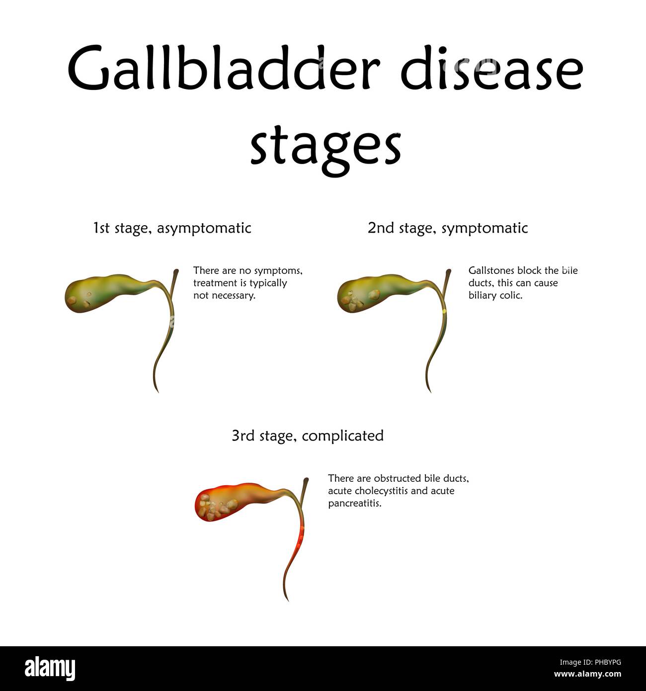 Erkrankung der Gallenblase Stadien, Illustration. Die Stufen zählen Entzündungen und Gallstoneanordnung. Stockfoto