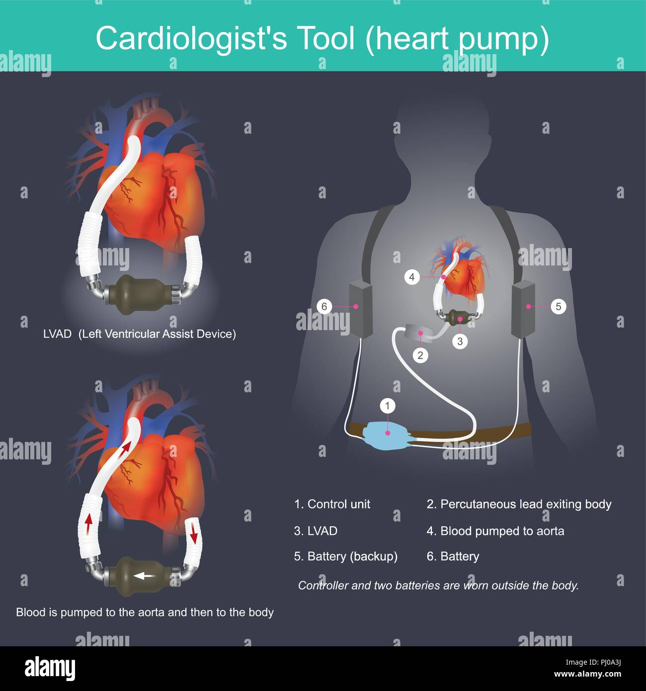 Dieses elektronische Gerät wird verwendet, um den Blutdruck aus dem Herzen der Aorta zu erhöhen. Stock Vektor