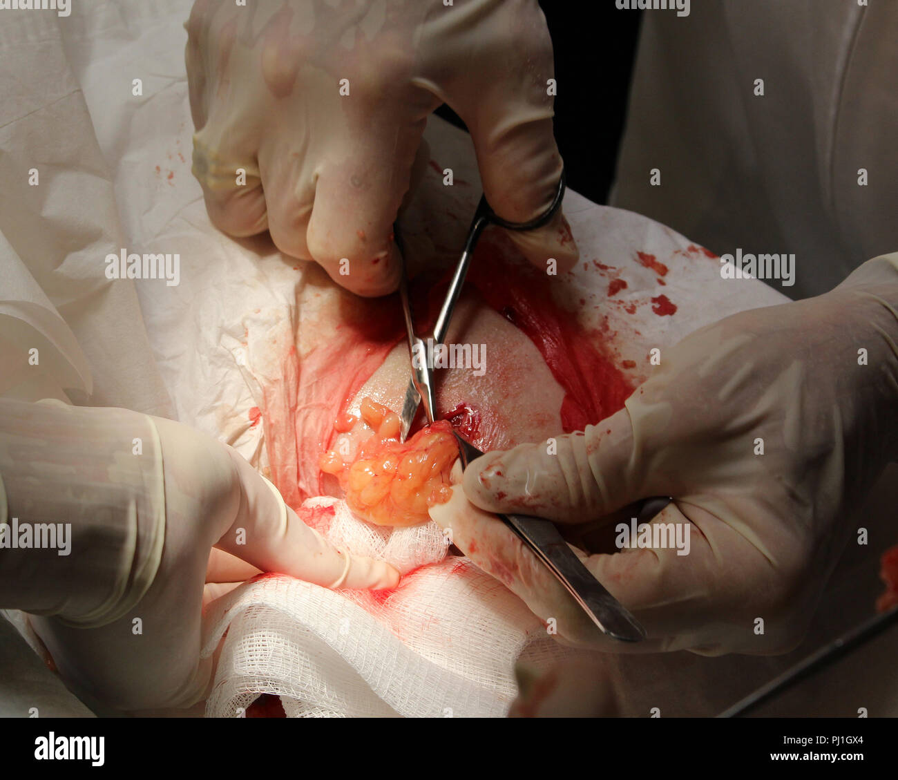 Tumor Removal Stockfotos &amp; Tumor Removal Bilder Alamy