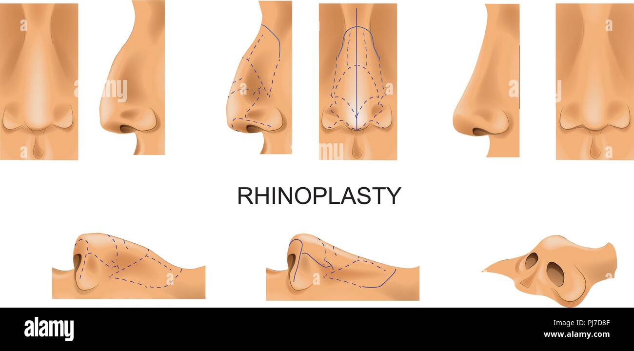 Vector Illustration der Nase. rhinoplastik. Plastische Chirurgie Stock Vektor