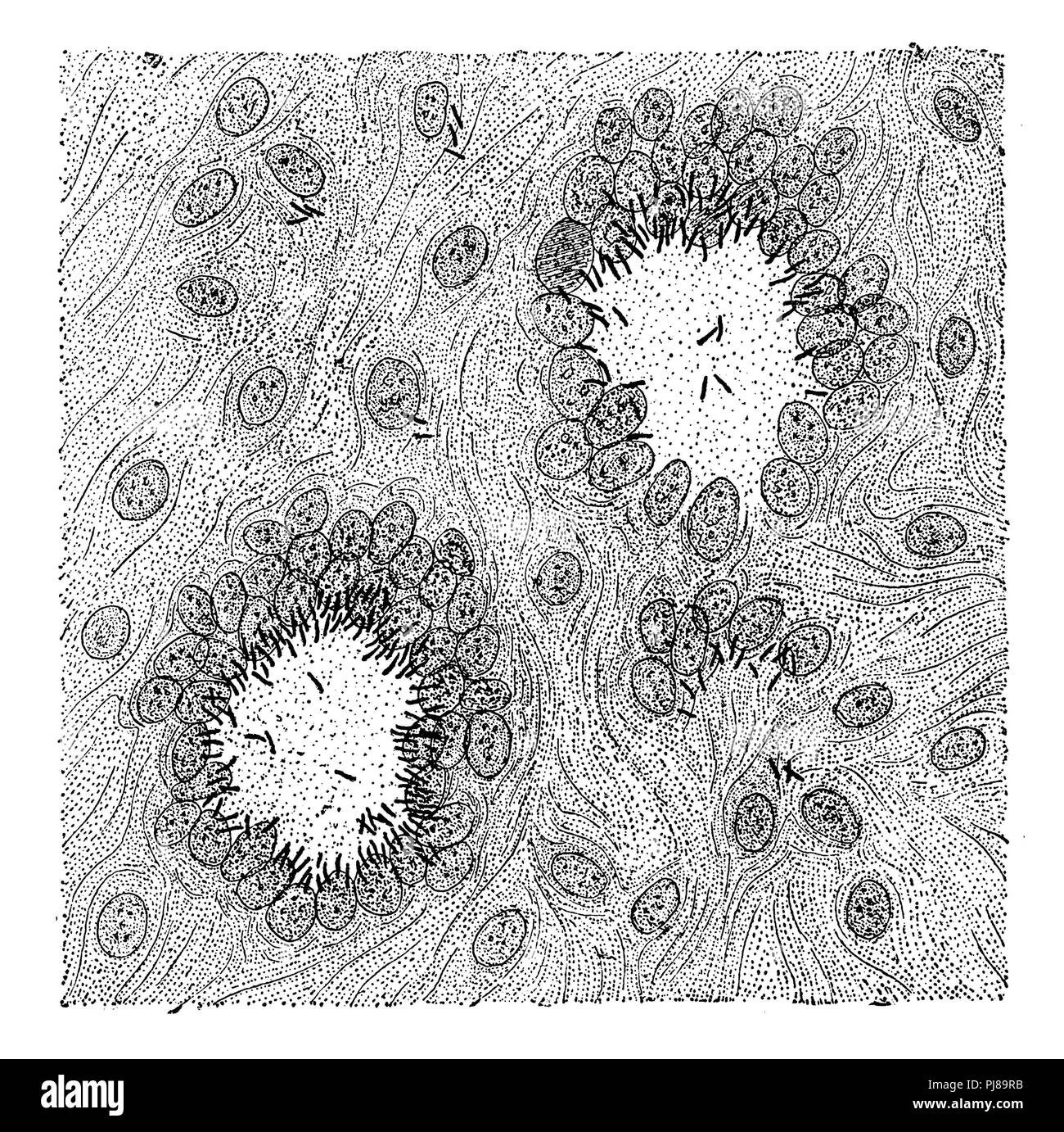 Tuberkulosebakterium: Schnitt durch ein tuberkel Knoten der Lunge, mit zwei riesigen Zellen mit tuberkel Bakterien infiziert (die schwarzen Linien sind die Tuberkulose Bakterien), anonym 1892 Stockfoto