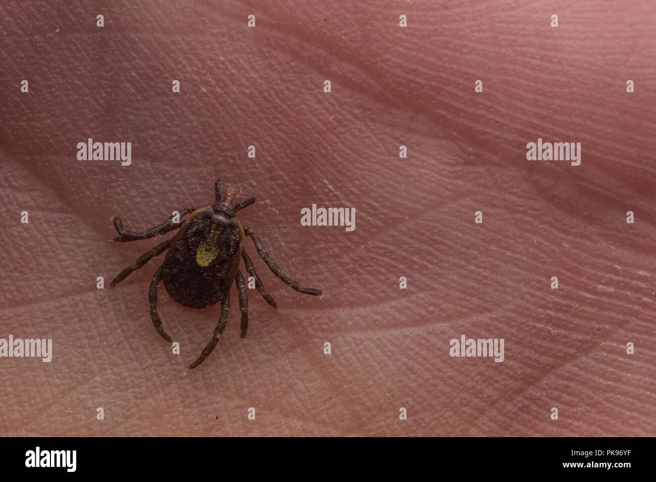 Ein eingebettetes tick aus Peru, Zecken sind als Überträger von Krankheiten, die die menschliche Gesundheit weltweit beeinflussen. Stockfoto