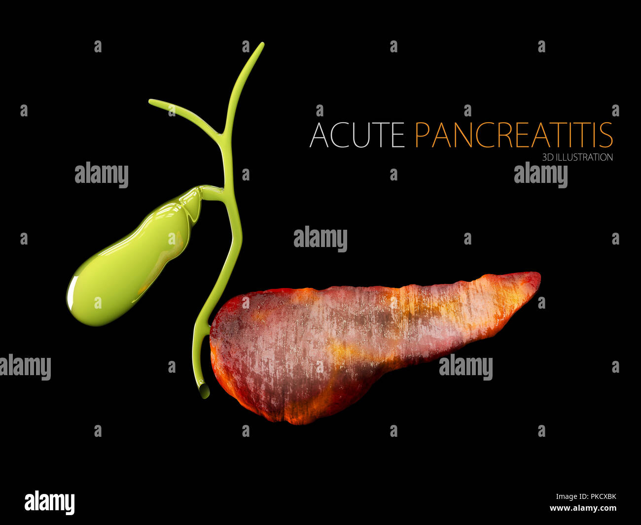 Akute Pankreatitis 3D-Illustration, Entzündung der Bauchspeicheldrüse auf schwarzem Hintergrund Stockfoto