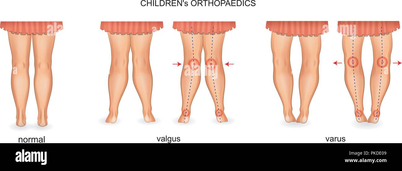 Vector Abbildung: Pädiatrische Orthopädie. valgus und Varus Stock Vektor