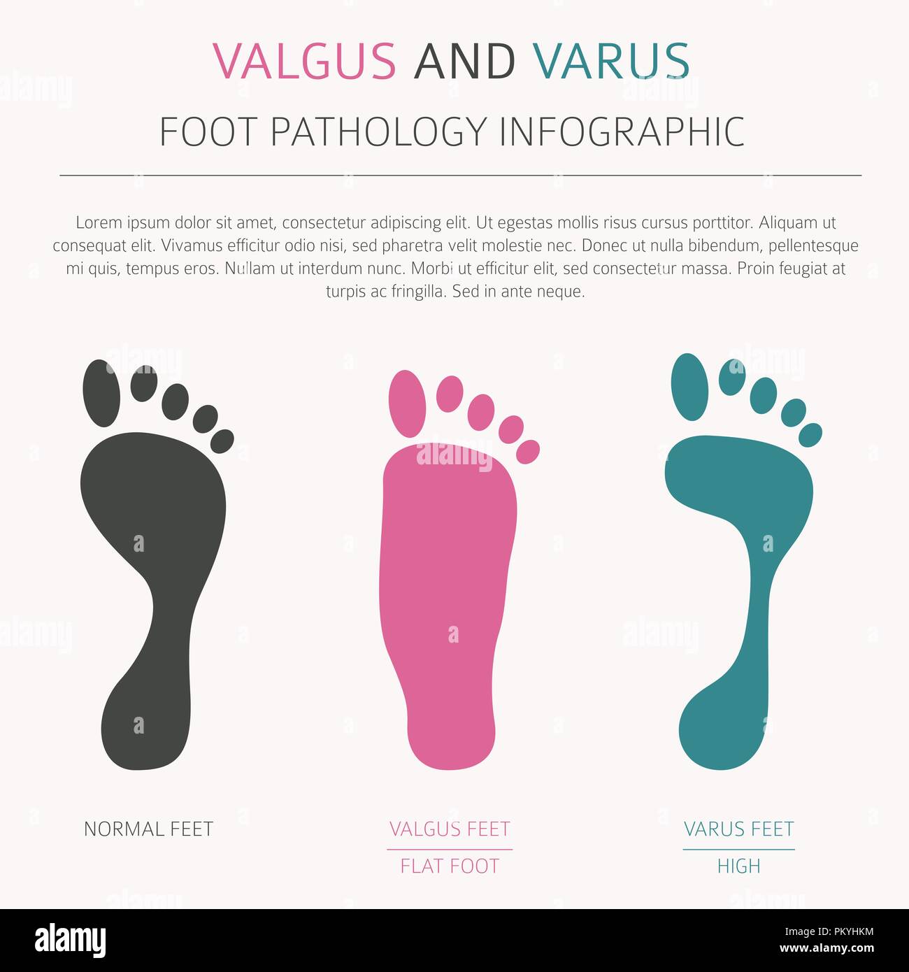 Fuß Verformung als medizinische Krankheit Infografik. Valgus und Varus defekt. Vector Illustration Stock Vektor