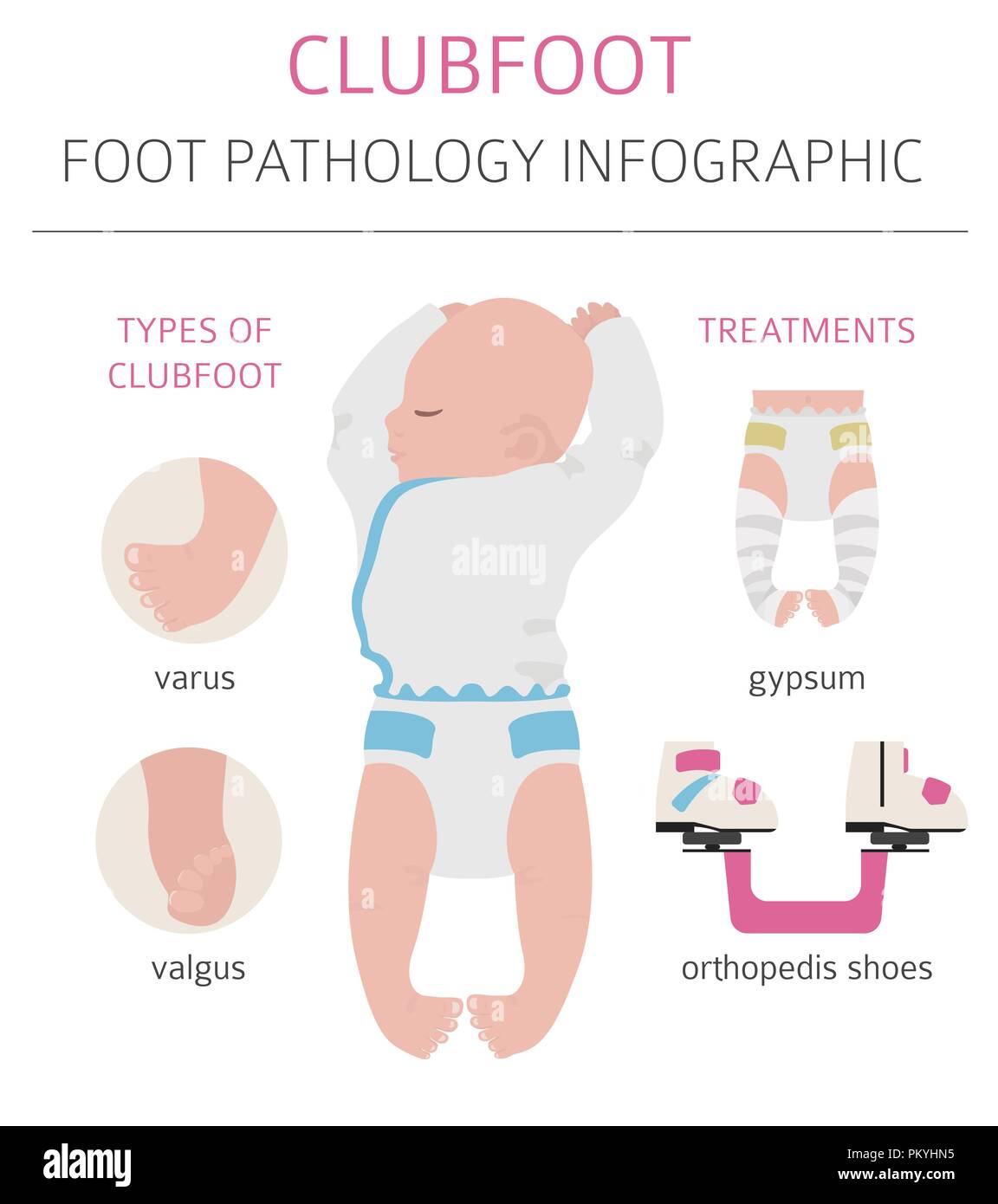 Fuß Verformung, medizinische Krankheit Infografik. Klumpfuß defekt. Vector Illustration Stock Vektor
