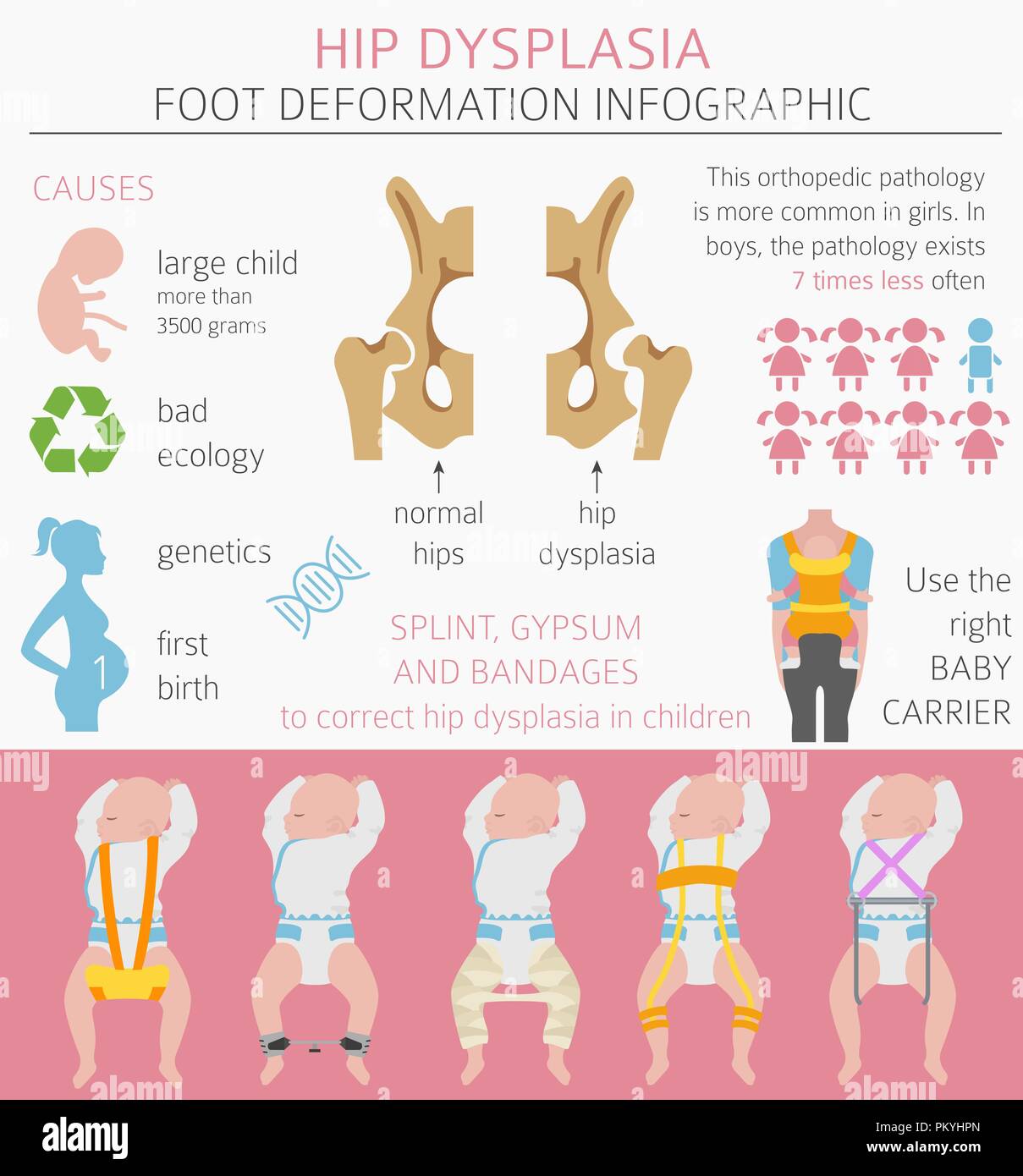 Fuß Verformung Arten, medizinische Krankheit Infografik. Hüftdysplasie bei Kindern. Vector Illustration Stock Vektor
