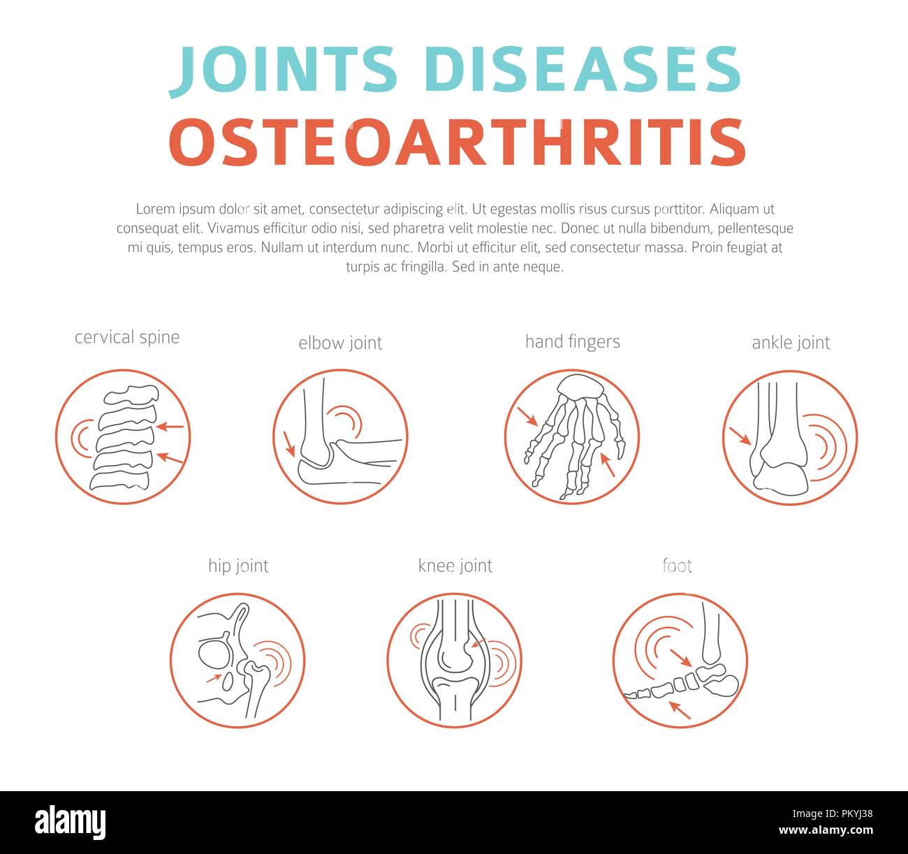 Gelenke Krankheiten. Arthritis, Arthrose Symptome, Behandlung Icon Set. Medizinische Infografik Design. Vector Illustration Stock Vektor