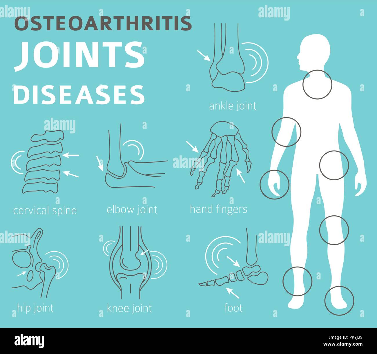Gelenke Krankheiten. Arthritis, Arthrose Symptome, Behandlung Icon Set. Medizinische Infografik Design. Vector Illustration Stock Vektor