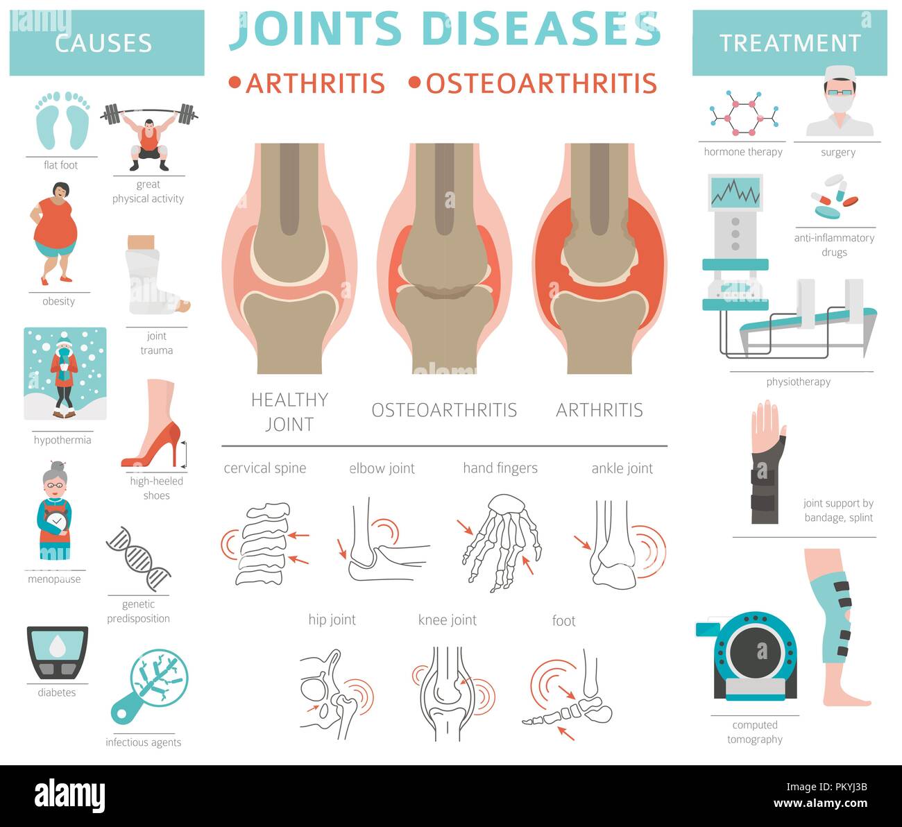 Gelenke Krankheiten. Arthritis, Arthrose Symptome, Behandlung Icon Set. Medizinische Infografik Design. Vector Illustration Stock Vektor