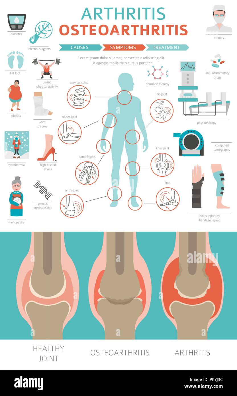 Gelenke Krankheiten. Arthritis, Arthrose Symptome, Behandlung Icon Set. Medizinische Infografik Design. Vector Illustration Stock Vektor