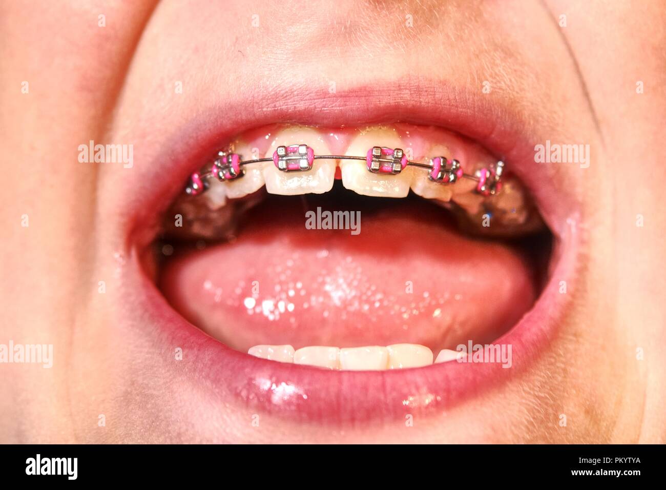 Junge zeigt Zahnspange mit Rosa gummierten Griffe Stockfoto