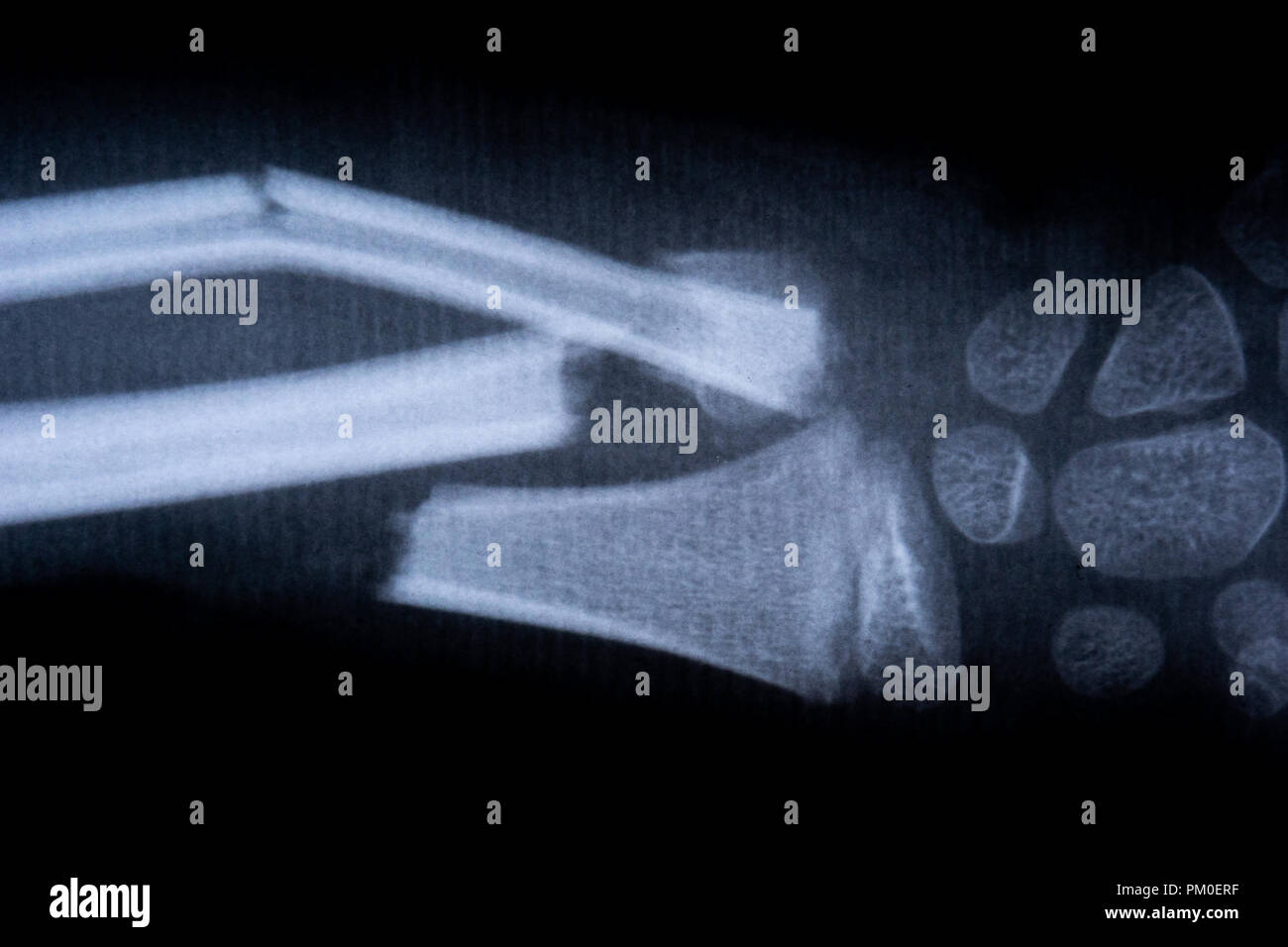 X-ray film Skelett menschlichen Arm. Gesundheit Medizin Anatomie Körper Konzept Stockfoto