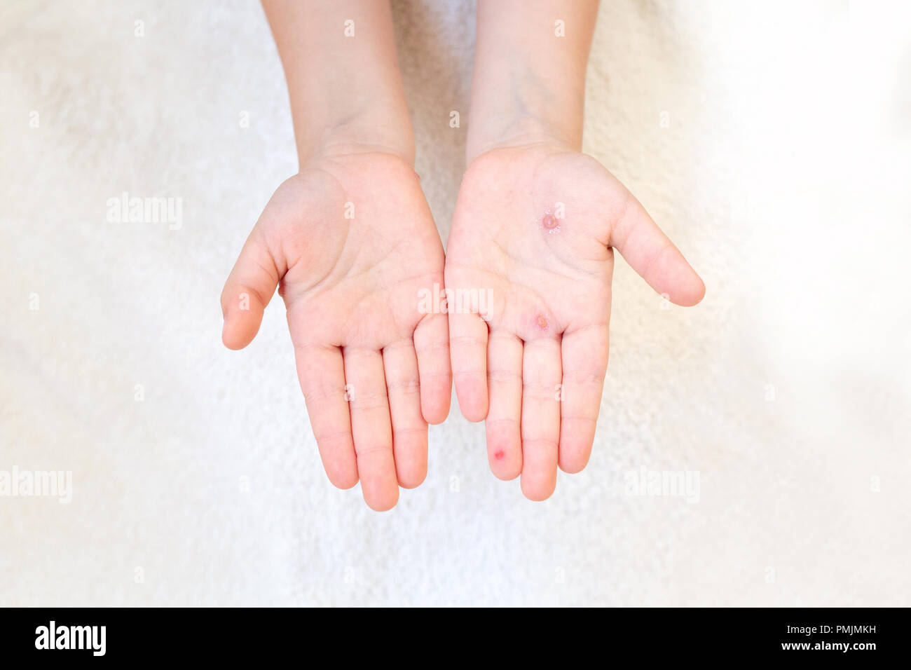 Die Hand eines Kindes mit Windpocken in der Hand der Mutter. Blasen an der Hand von Windpocken. Stockfoto