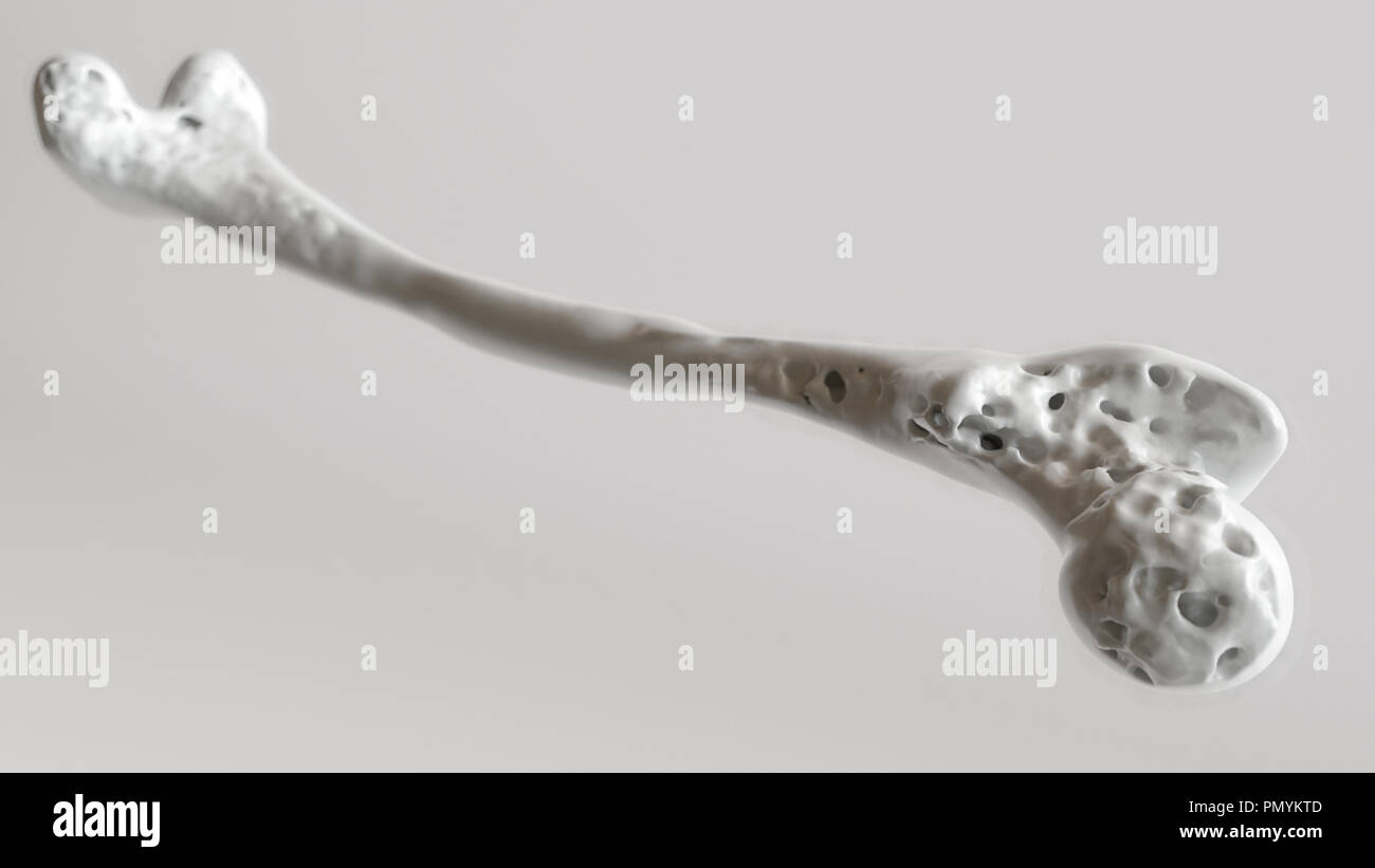Osteoporose-Stufe 3 von 4 - Obere Extremität-Knochen - 3d rendering Stockfoto