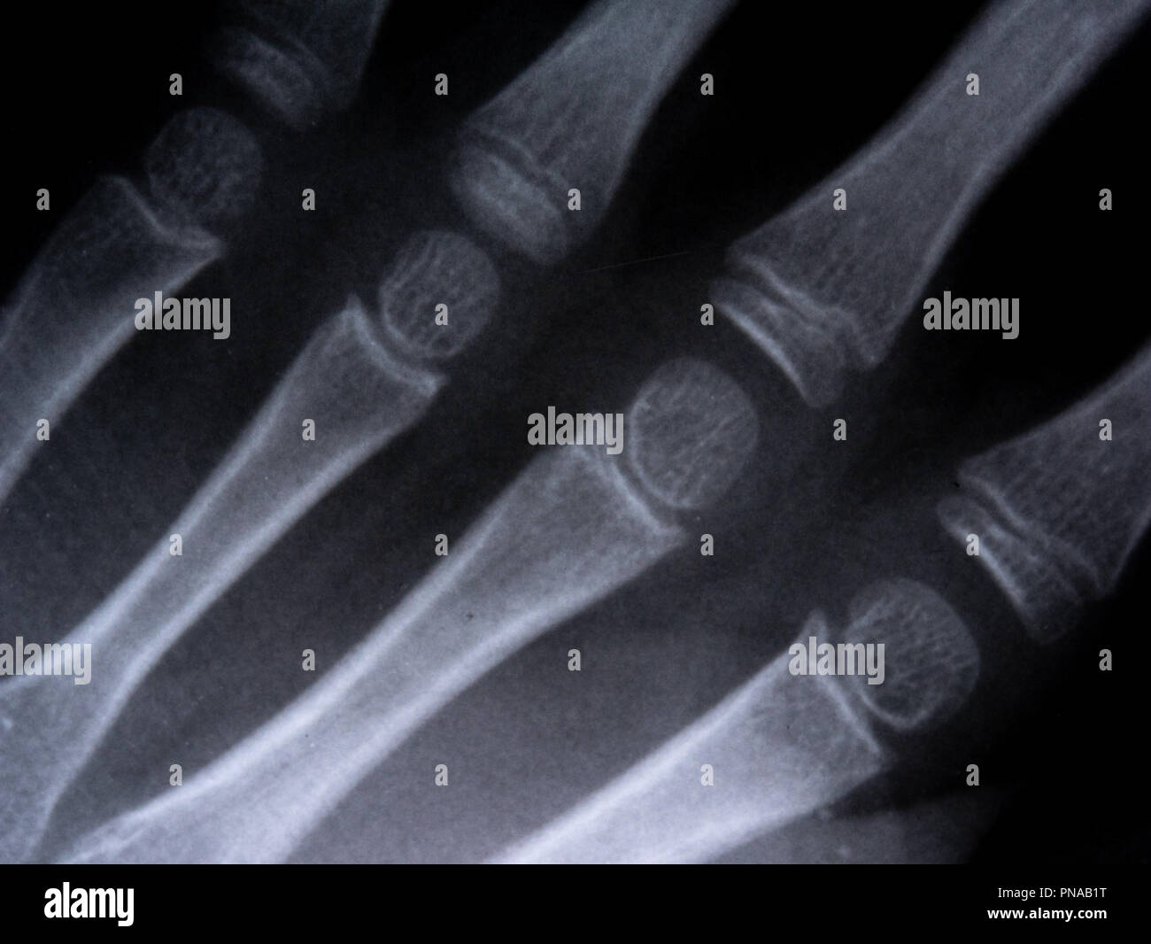 X-ray film Skelett menschlichen Arm. Gesundheit Medizin Anatomie Körper Konzept Stockfoto