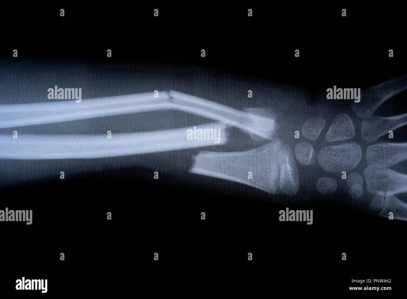 X-ray film Skelett menschlichen Arm. Gesundheit Medizin Anatomie Körper Konzept Stockfoto