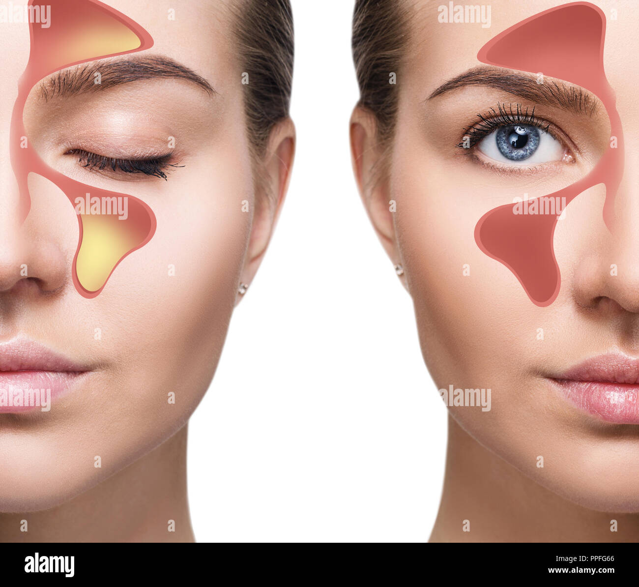 Weibliche Gesicht zeigt nasal Sinus mit kalten weißen Hintergrund. Stockfoto