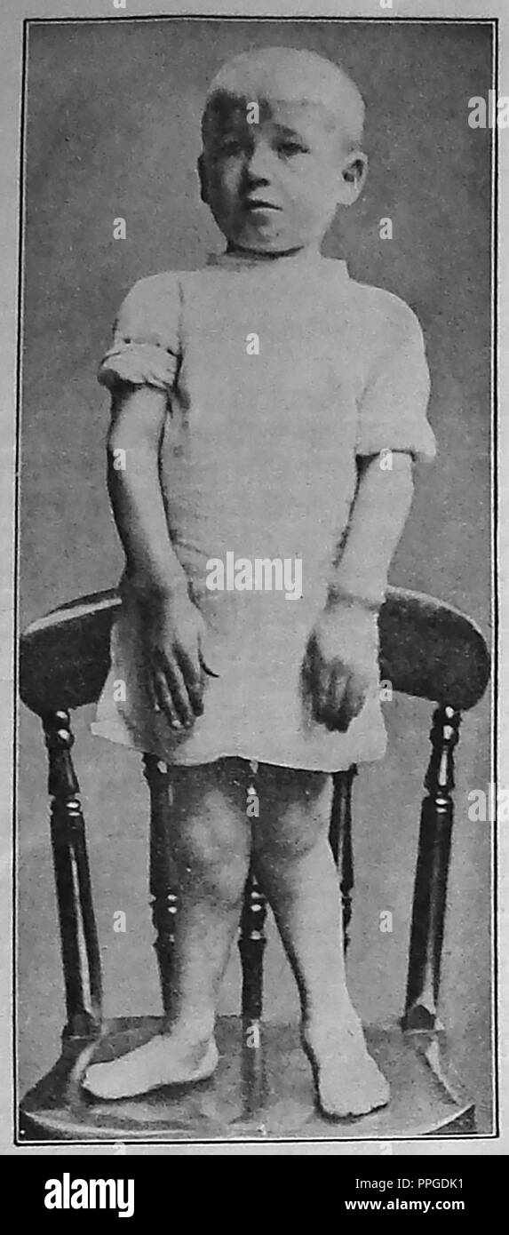Eine 1920 Abbildung: ein Kind mit Rachitis, die Symptome von deformierten Beine und verdickte Handgelenke und Knöchel Stockfoto