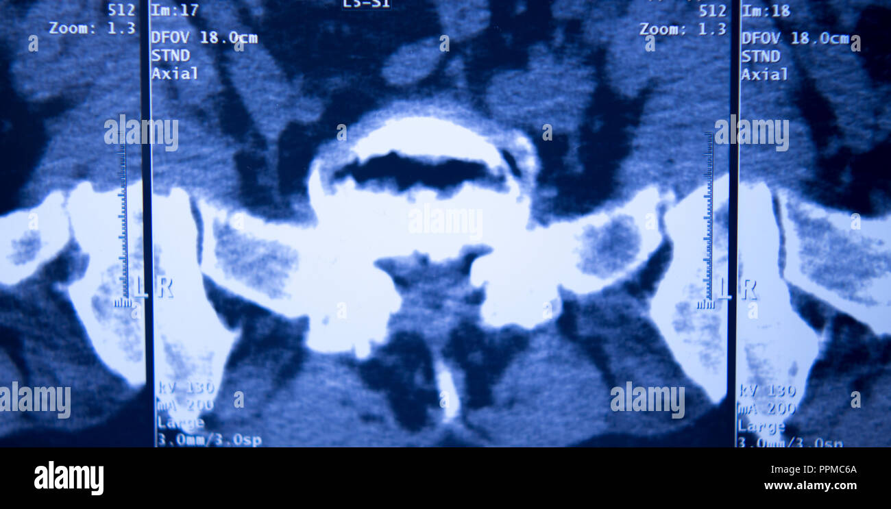 Medizinische Klinik x-ray Hüfte Wirbelsäule Becken MRI Traumatologie scannen. Stockfoto