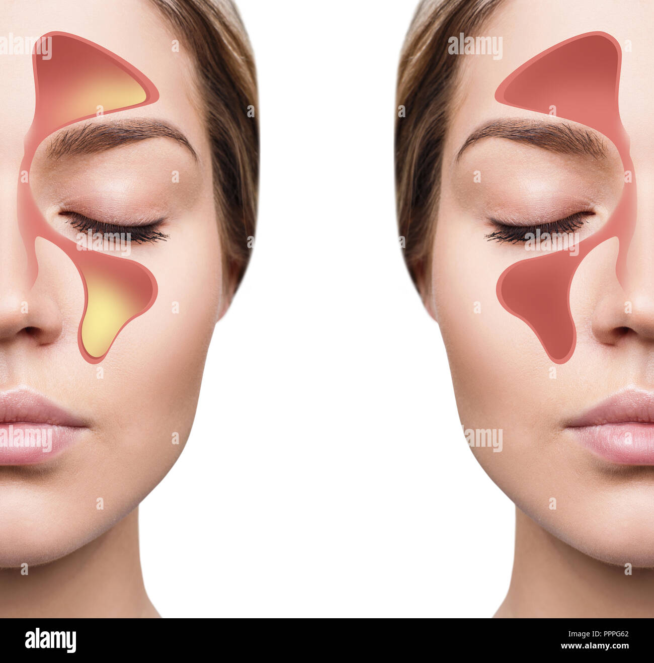 Weibliche Gesicht zeigt nasal Sinus mit kalten weißen Hintergrund. Stockfoto