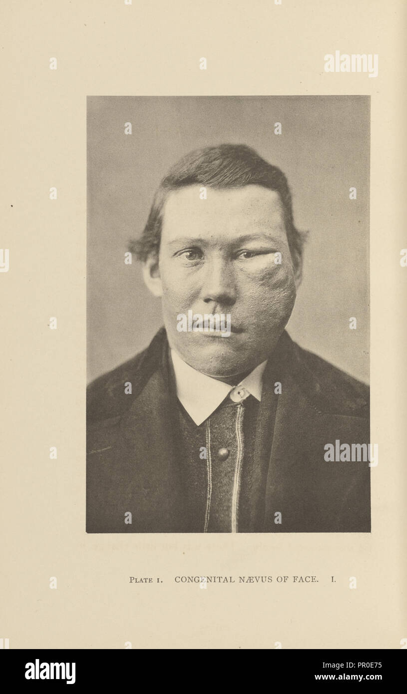 Angeborene naevus Fotos und Bildmaterial in hoher Auflösung Alamy