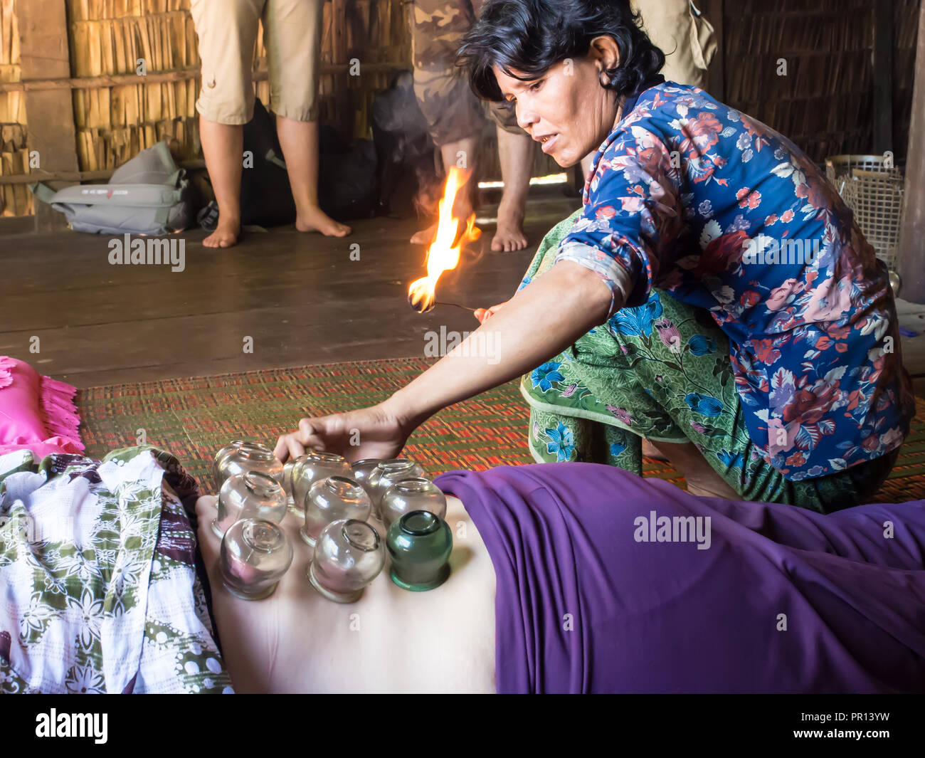 Traditionelle Heilmethode, die von Feuer schröpfen, Dorf in der Nähe von Siem Reap, Kambodscha, Indochina, Südostasien, Asien Stockfoto