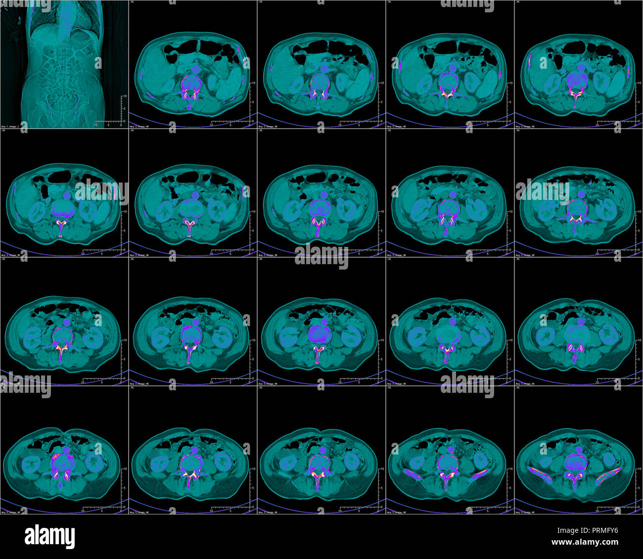 Die Brust in der Computertomographie, CT-Bild Stockfoto