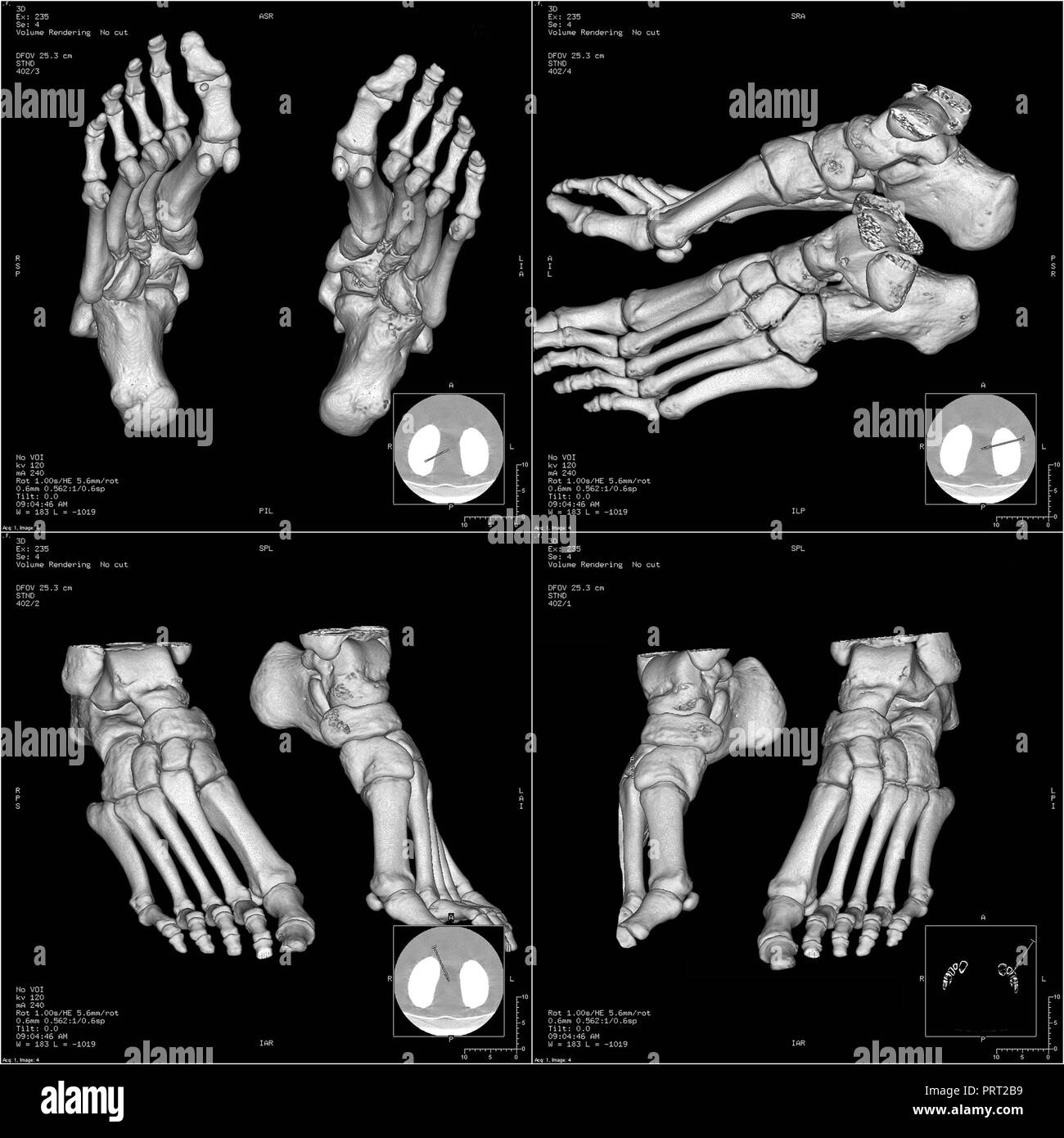 Knochen der Fuß in dreidimensionale CT- Stockfoto