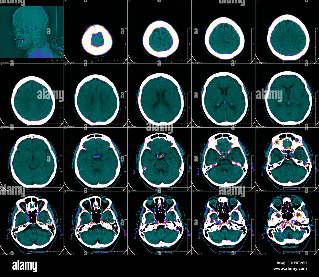 Kopf in der Computertomographie, CT-Bild Stockfoto