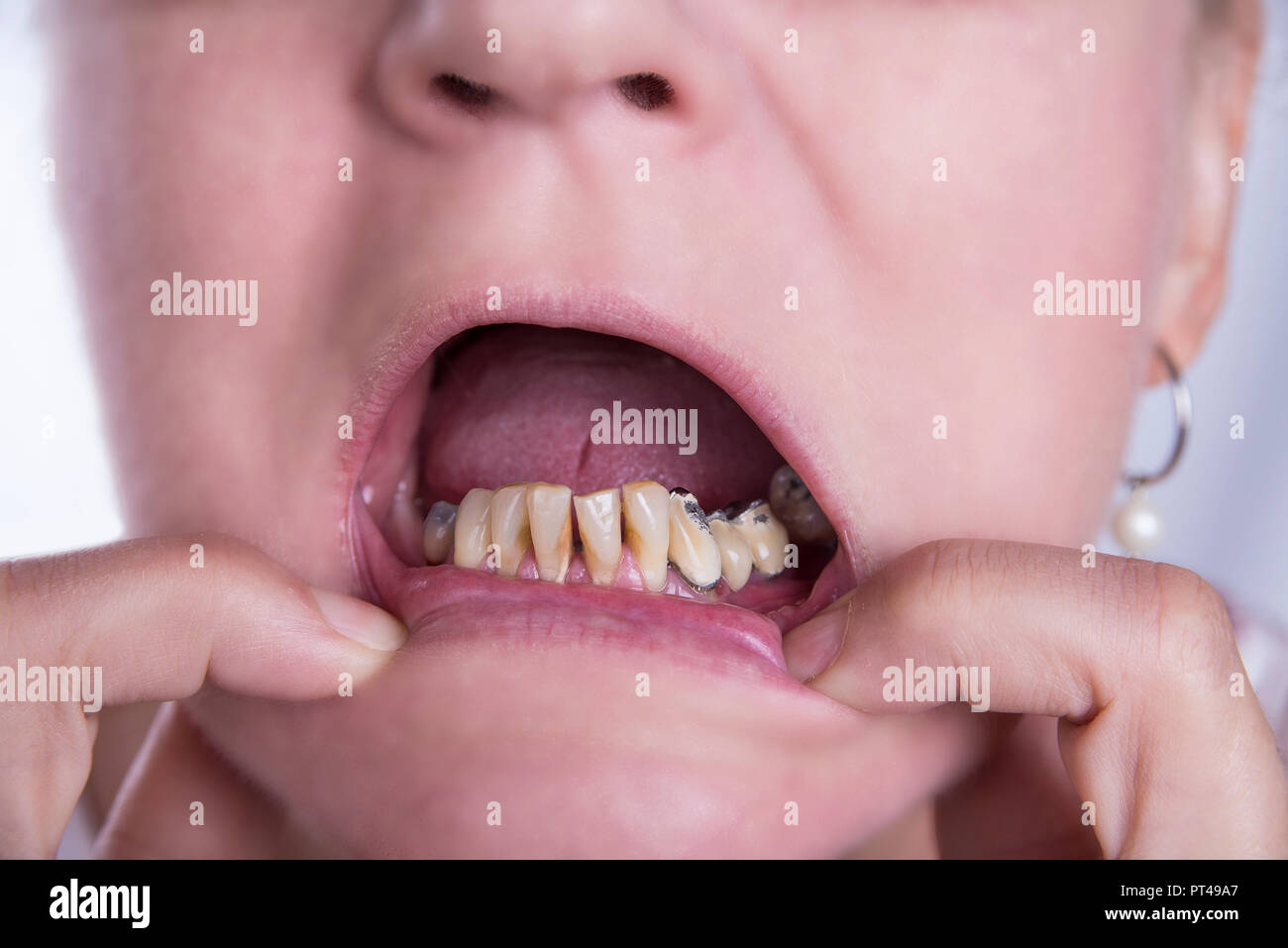 20 schlechte zähne mit Schlechte Zähne