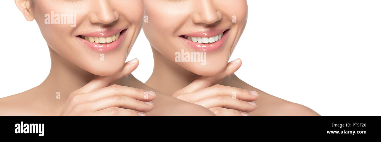 Frau Lächeln vor und nach dem Bleichen von Zähnen isoliert auf weißem Stockfoto