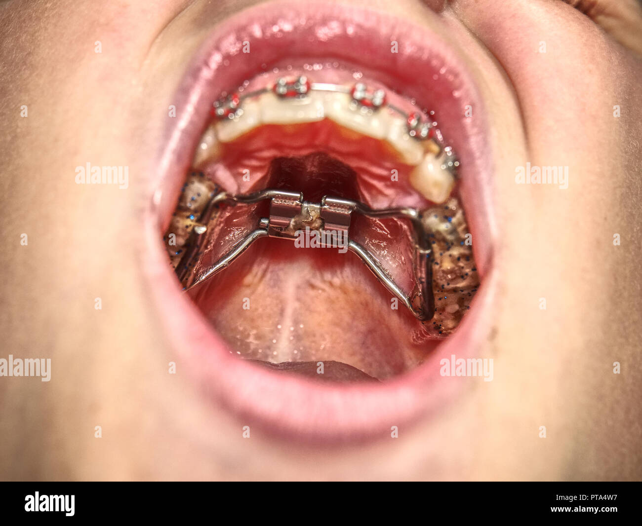 Brackets Boy Stockfotos & Brackets Boy Bilder - Alamy