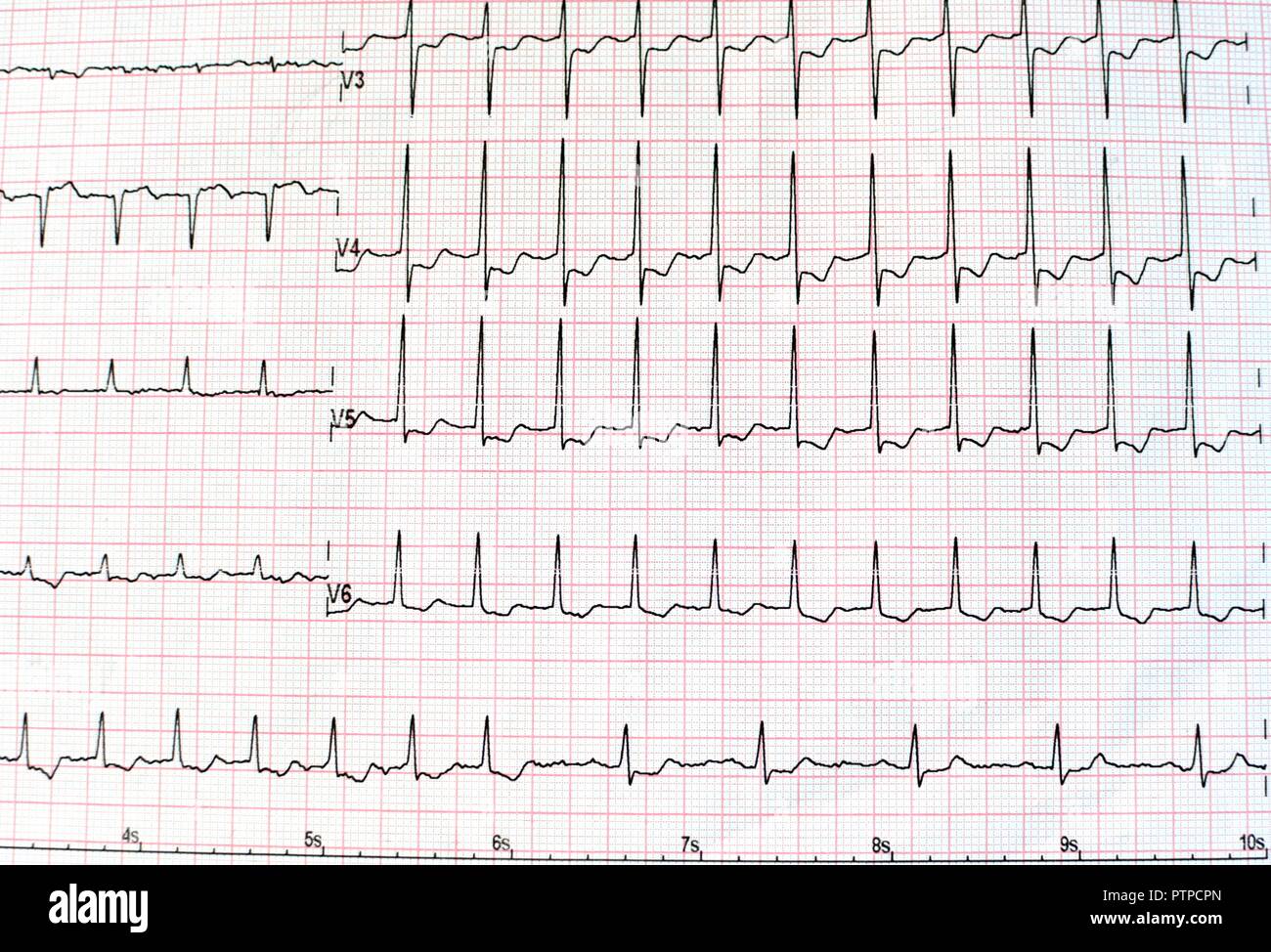 Blick von oben auf ein Elektrokardiogramm in gedruckter Form für Gesundheitswesen und medizinische Konzept oder Hintergrund. EKG oder EKG, von oben gesehen Stockfoto