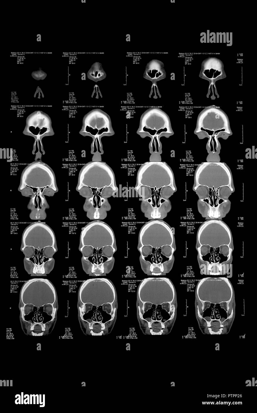 Kopf in der Computertomographie, CT-Bild Stockfoto