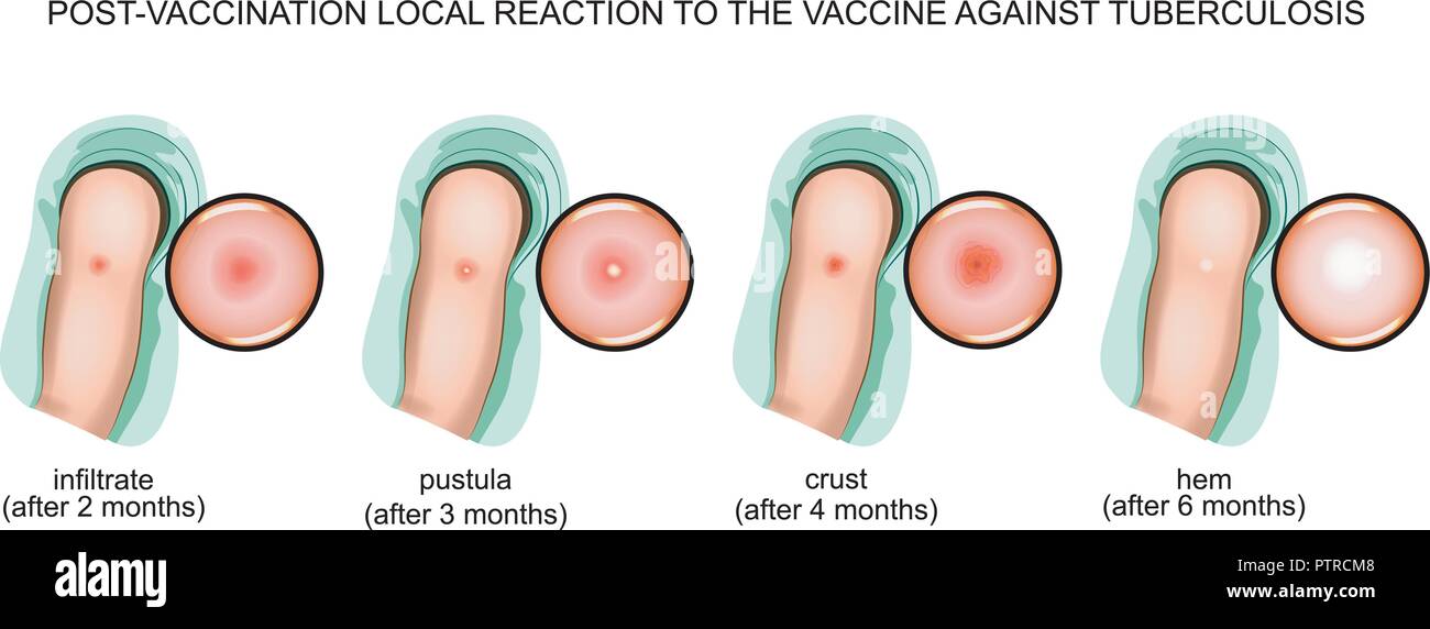 Vector Abbildung: Reaktionen nach der Impfung mit dem Impfstoff gegen Tuberkulose Stock Vektor