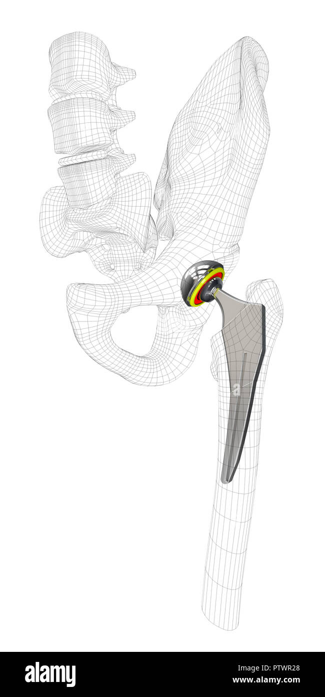 3D-Darstellung der Hip Joint Replacement, isolierte Grau. Stockfoto