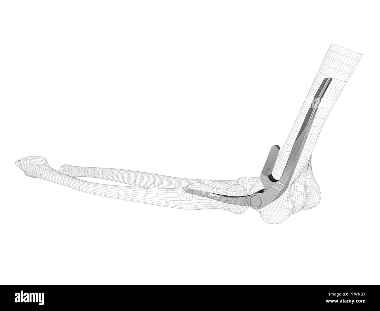 3D-Darstellung der Endoprothetik des Ellbogengelenks. Stockfoto