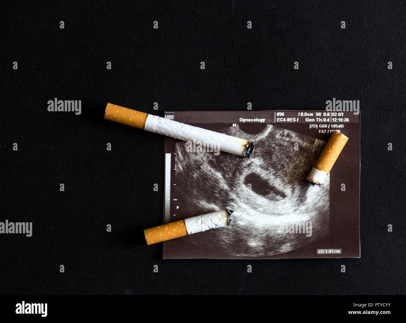 Zigarette Zigarettenstummel gelöscht über einen Schuß von Schwangerschaft, Schwangerschaft und Rauchen, Zigarette und Trächtigkeit Stockfoto