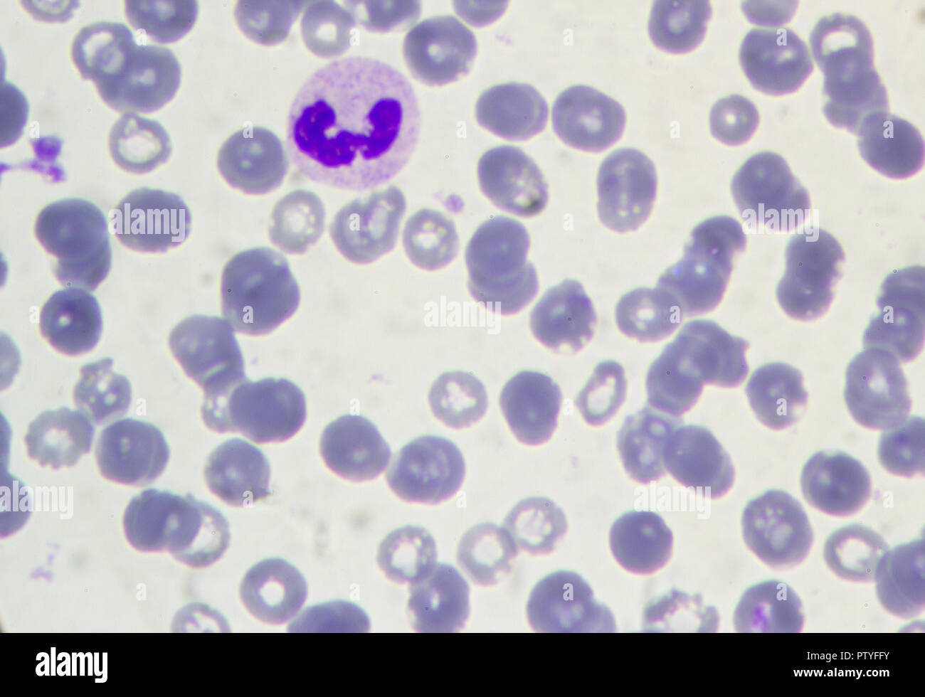 Blut unter dem Mikroskop. Lymphozyten. Stockfoto